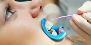dental sealants Dr. Joe Thomas Dentistry