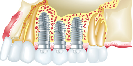 DJT_Implants-01