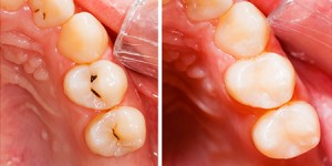 before and after tooth cavity Dr. Joe Thomas Dentistry