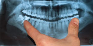 Dental x-ray Dr. Joe Thomas Dentistry