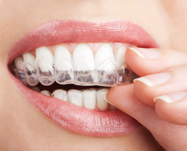 Invisalign Dr. Joe Thomas Dentistry